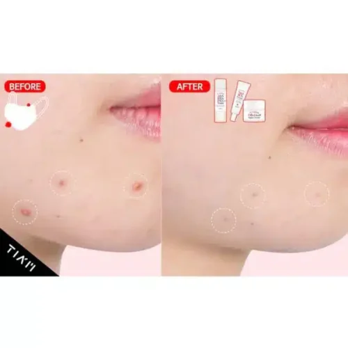 TIAM-AC-Fighting-Spot-RX-Cream-2-640x640_grande